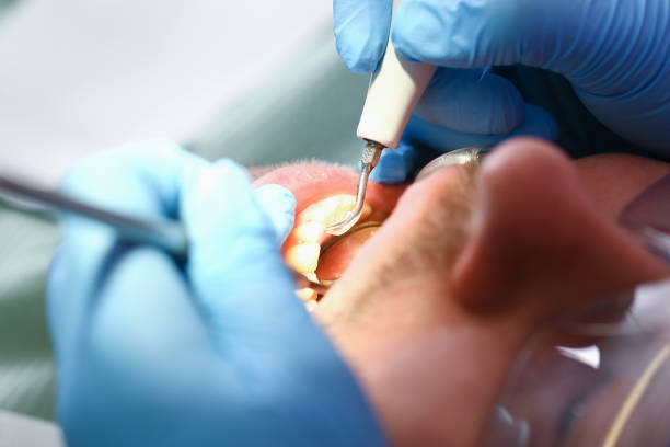 Best Emergency Root Canal Treatment in Kendallville, IN
