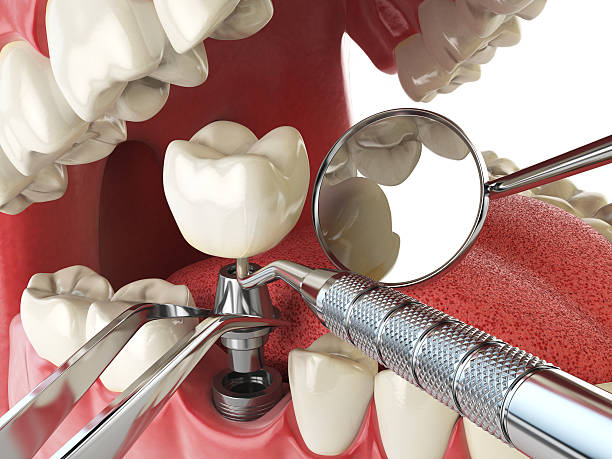 Best Emergency Root Canal Treatment in Kendallville, IN
